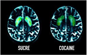 scan cerveau avec sucre ou cocaïne